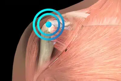 tendinitis del infraespinoso